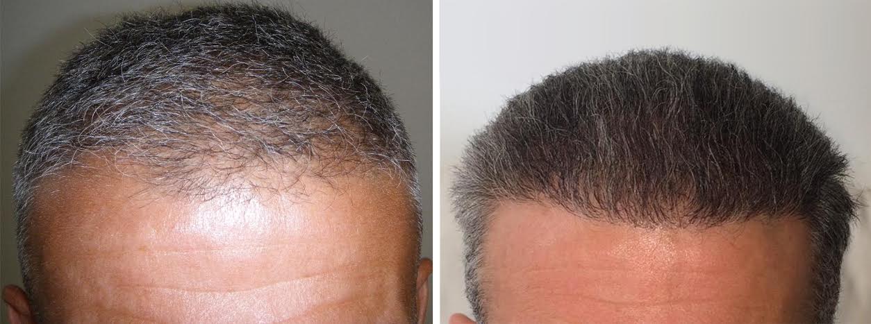 hairpalace reference hair transplant photo hairpalace reference hair transplant photo