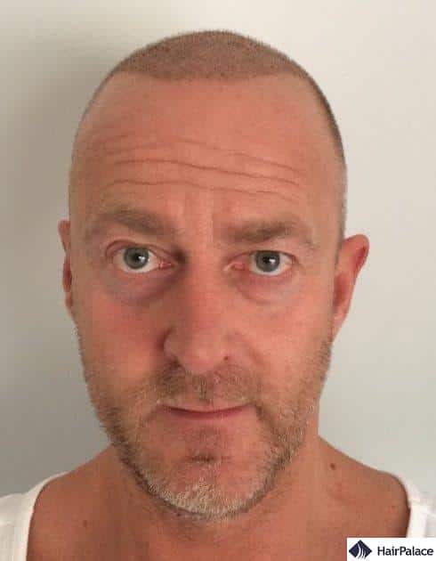 Richard 1 week after hair transplant