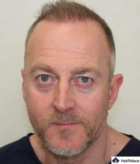 Richard 10 months after hair transplant