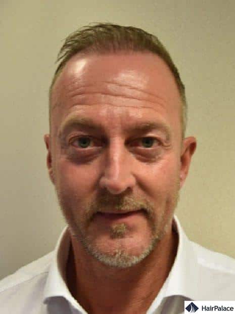 Richard 6 months after hair transplant