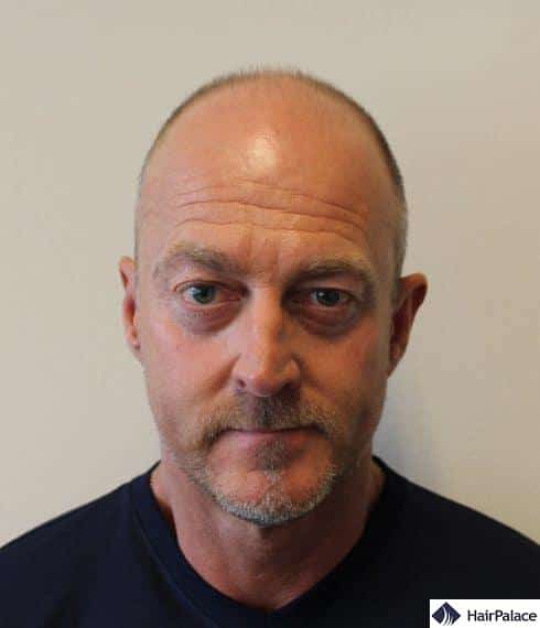 Richard before hair transplant