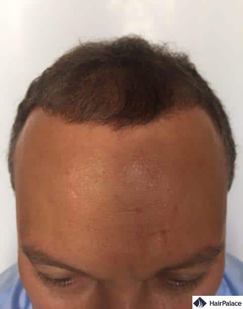 Valko 3 months after the hair transplant