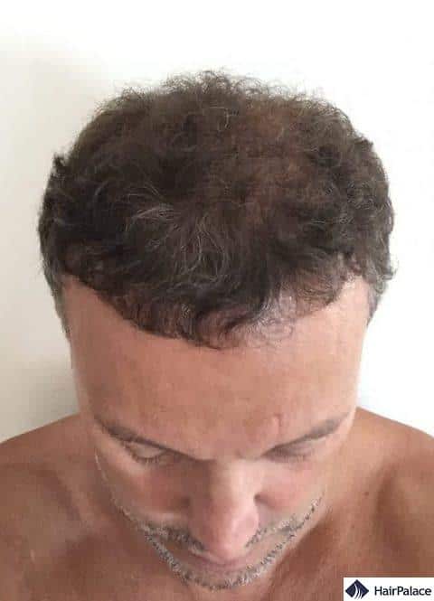 Valko 6 months after the hair transplant