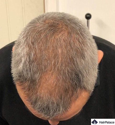 density restoration - 3 months after hair transplant
