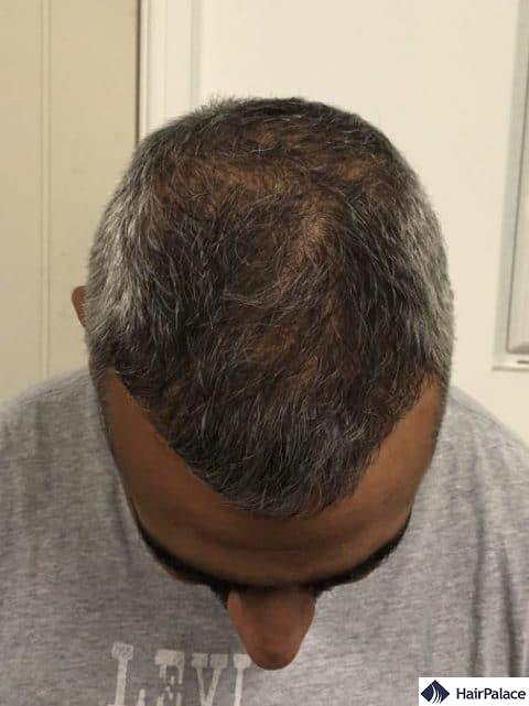 density restoration - 6 months after hair transplant