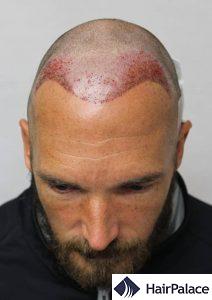 Recipient area after the hair transplant surgery