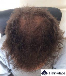 High and even density at the front 6 months post hair transplant