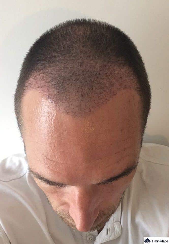 The recipient area 3 weeks post hair transplant