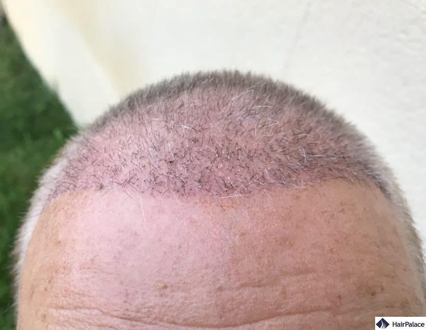 Denis' implanted hairline 3 weeks after the hair transplant