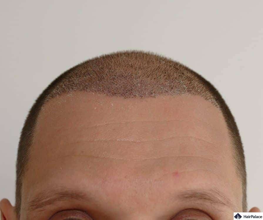 Jessy's implanted area a week after the hair transplant with some scabs visible