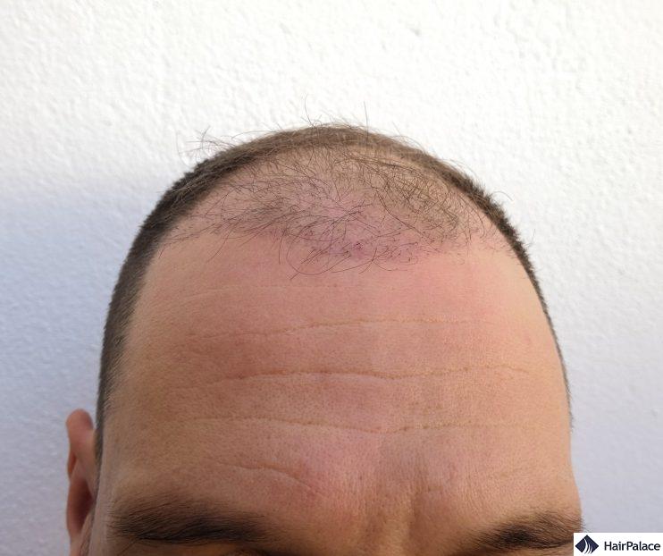 The recipient area 3 months after the surgery with the hairs fallen out