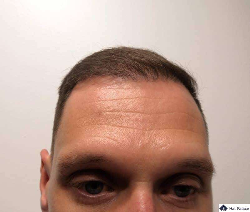 Partial result at the hairline 6 months after the FUE2 hair transplant
