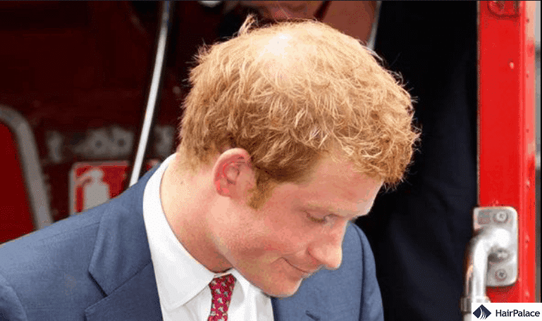 The thinning hair of Prince Harry