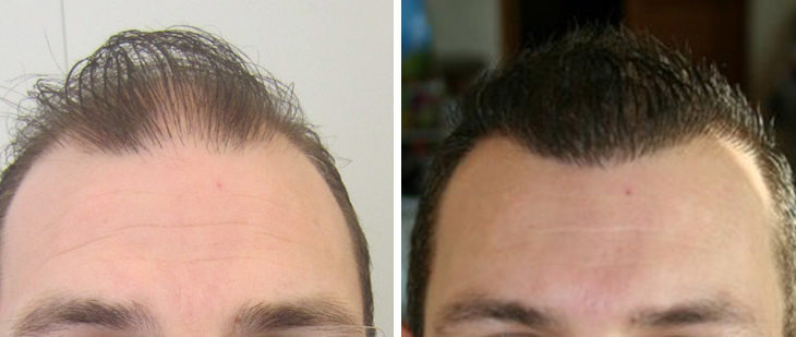 Hair Transplant Post Op Pictures: See Yannick Real Transformation
