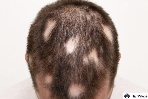 alopecia areata may cause itchy scalp and hair loss