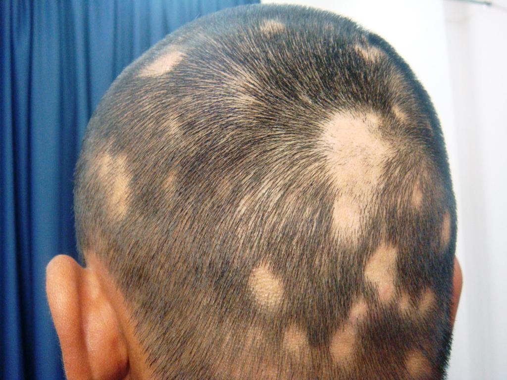 The results of alopecia areata