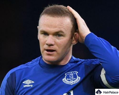 Exploring The Cost Of Wayne Rooney S Hair Transplant Hairpalace