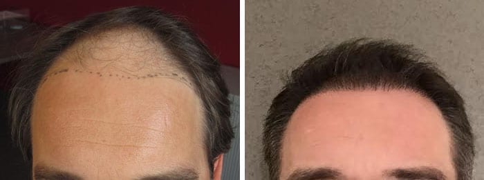 Bruno before and after the hair transplant.