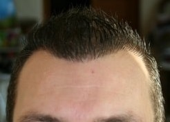 1 year after hair transplant