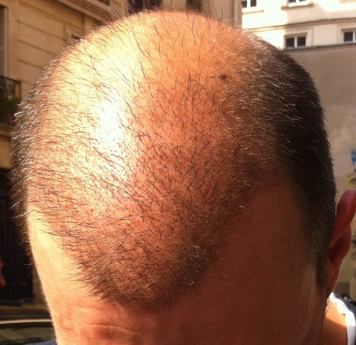 3 weeks after the hair transplant surgery