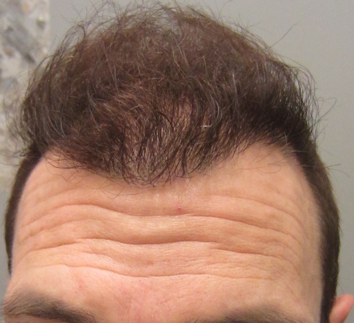 6-months-after-hair-transplant