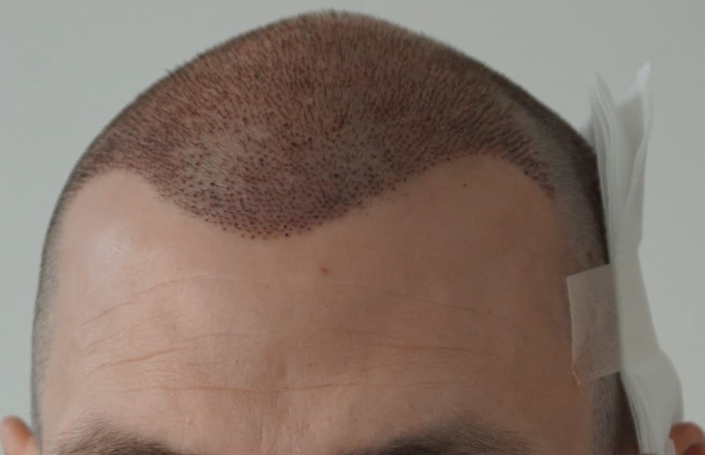 after-hair-transplant