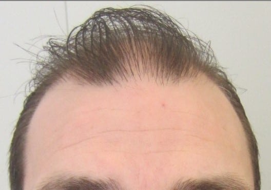 Before the hair transplant