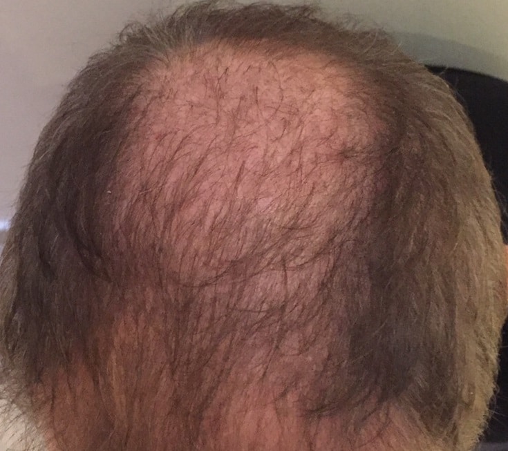 3-months-vertex-greffe-de-cheveux