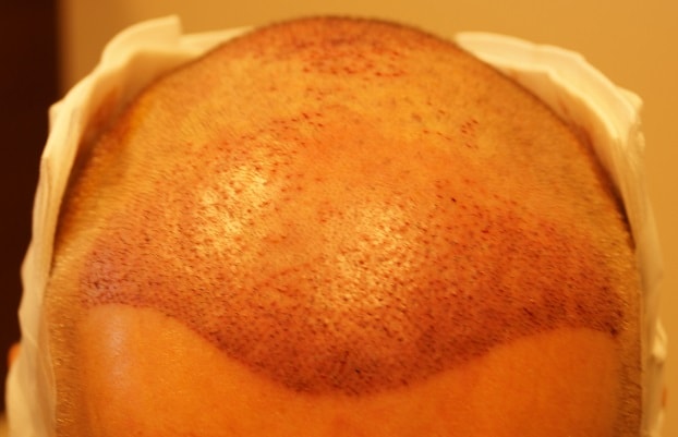 front-hair-transplant-surgery-after