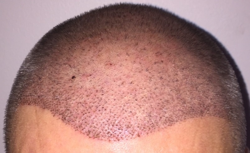 hair-transplant-front-1-week
