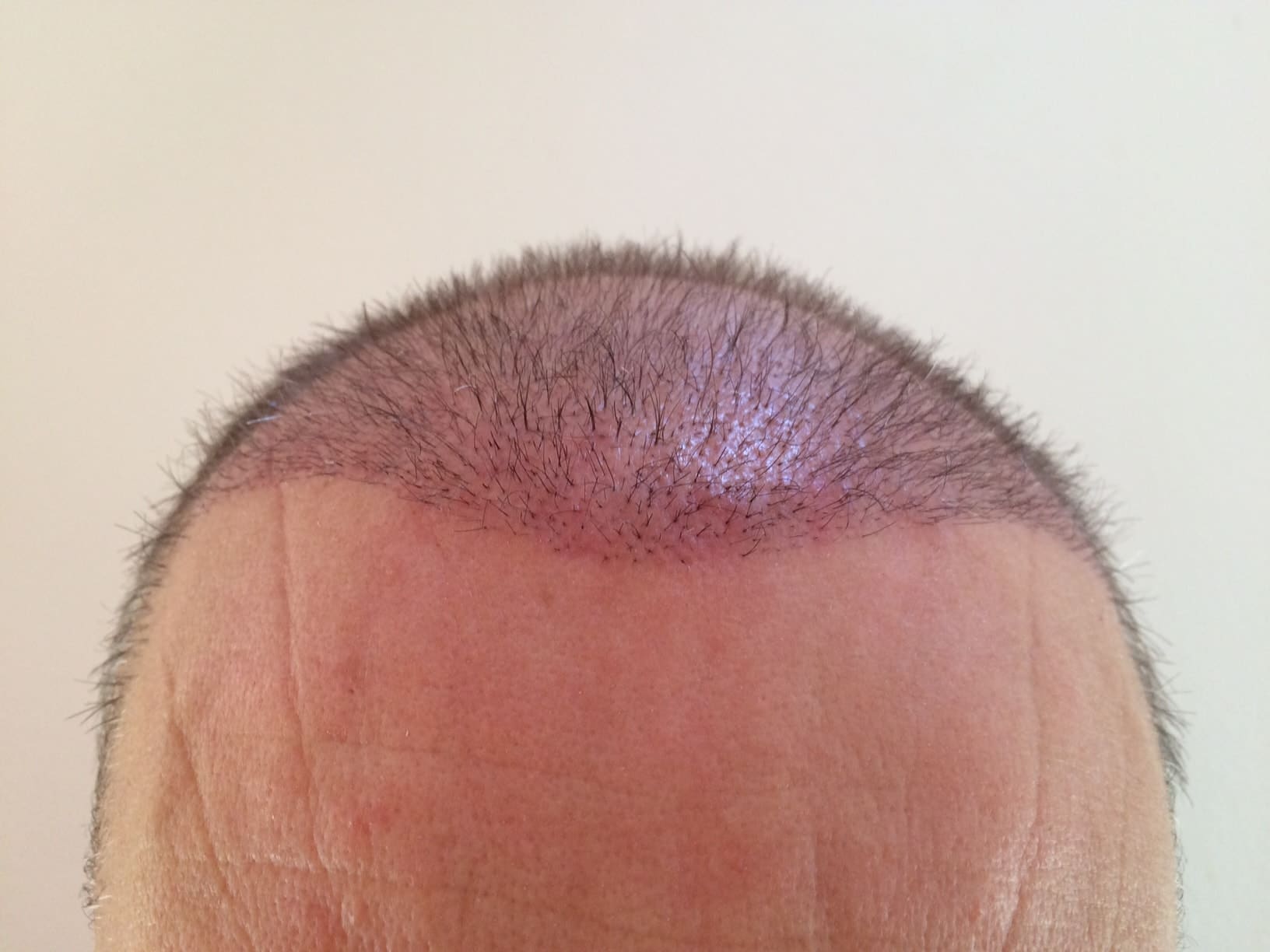 hair-transplantation-3-weeks