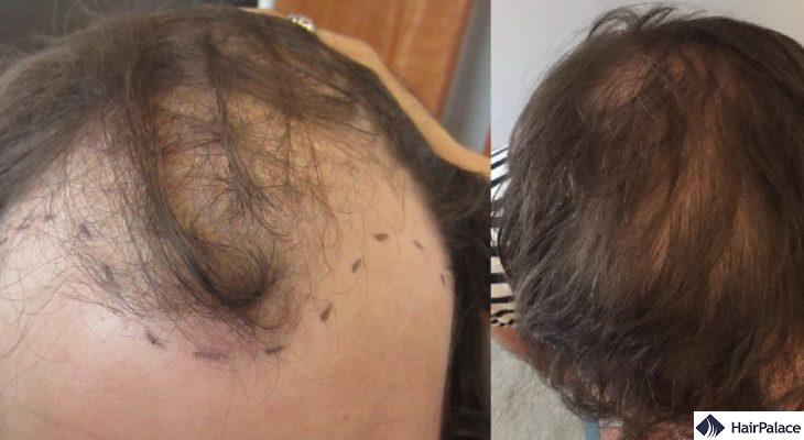 Mark before-after 6000 hairs