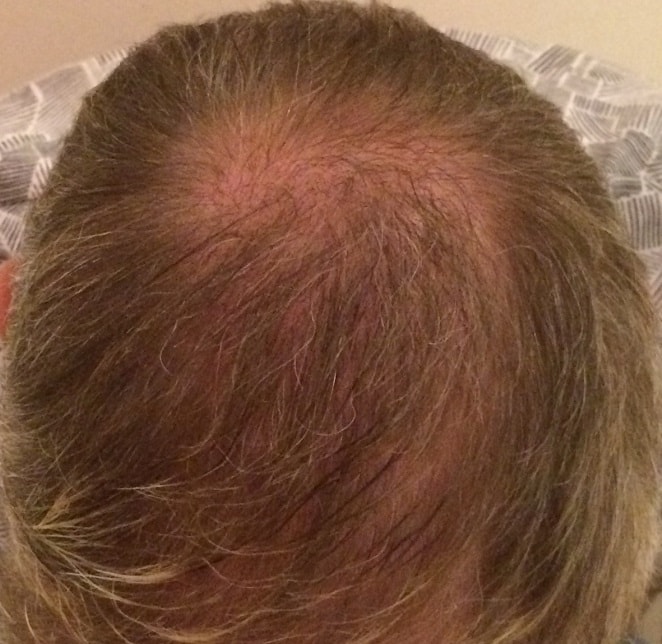 vertex-hair-transplant-surgery-1-year