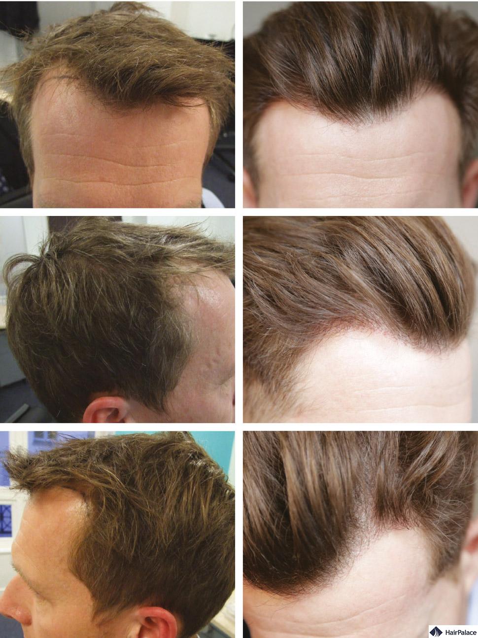 HairPalace Hair Transplantation Clinic in Hungary (EU HairPalace Hair Transplantation Clinic in Hungary (EU