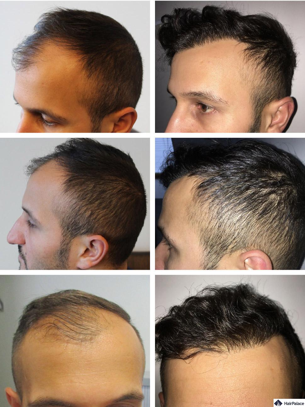 HairPalace Hair Transplantation Clinic in Hungary (EU) Save 50