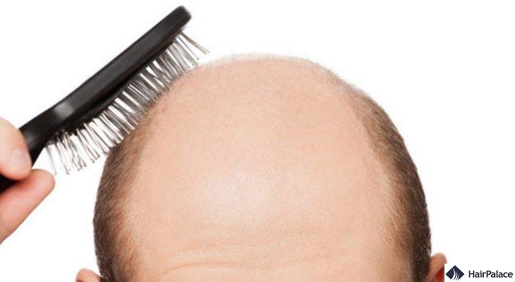 What Causes Hair Loss 9 Common Causes Hairpalace Hairclinic