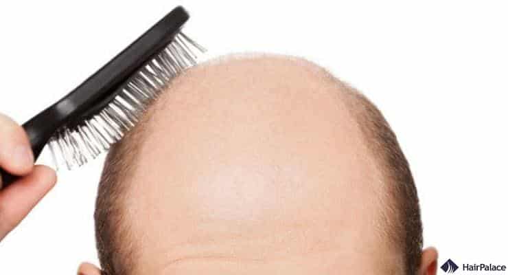 hair loss causes