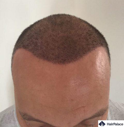 Valko 1 week after the hair transplant