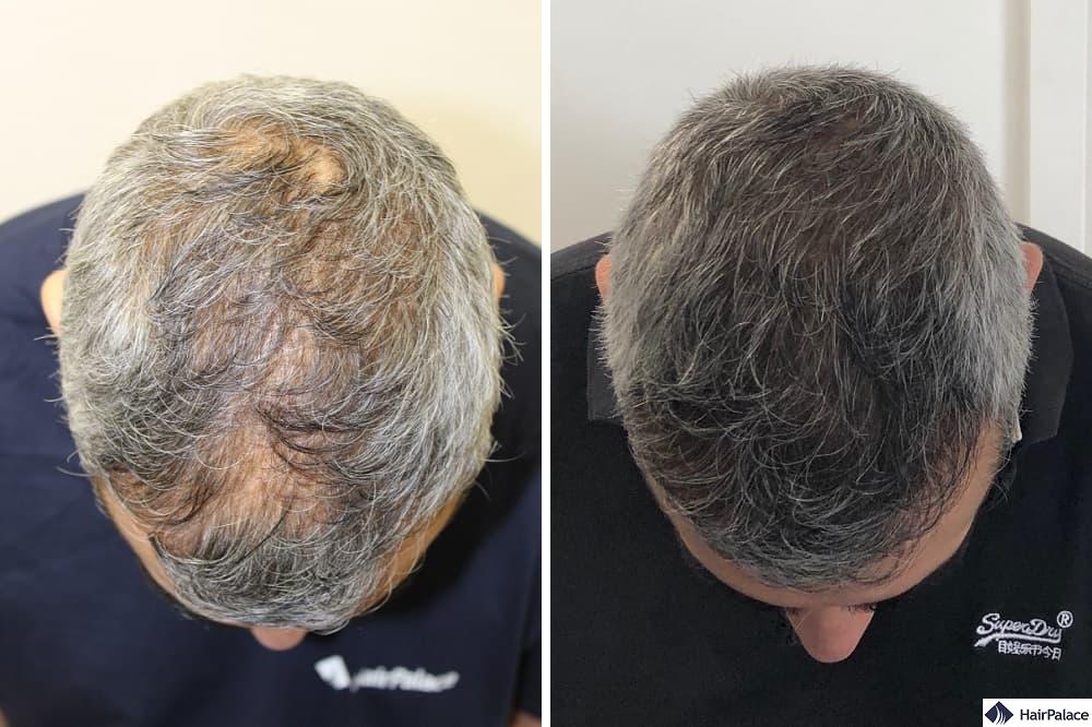 Ezra before after hair transplant Hair Palace FUE Hair Transplant in Budapest
