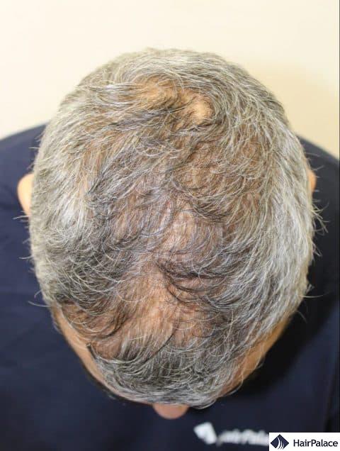 density restoration - before hair transplant surgery