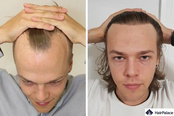Impressive Results with 6000 Hairs – Bartlomiej's Case