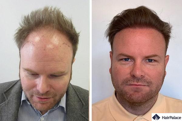 Hair Transplant Surgery