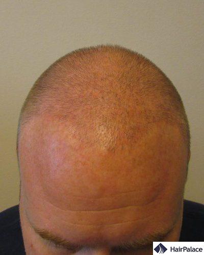  David's result after one hair transplant