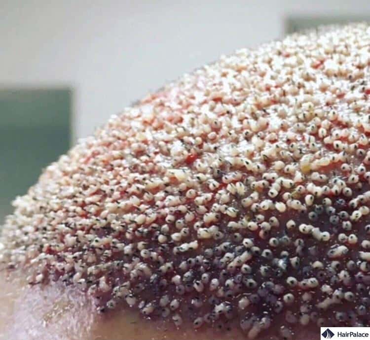 swelling after hair transplant might cause infection if left unchecked