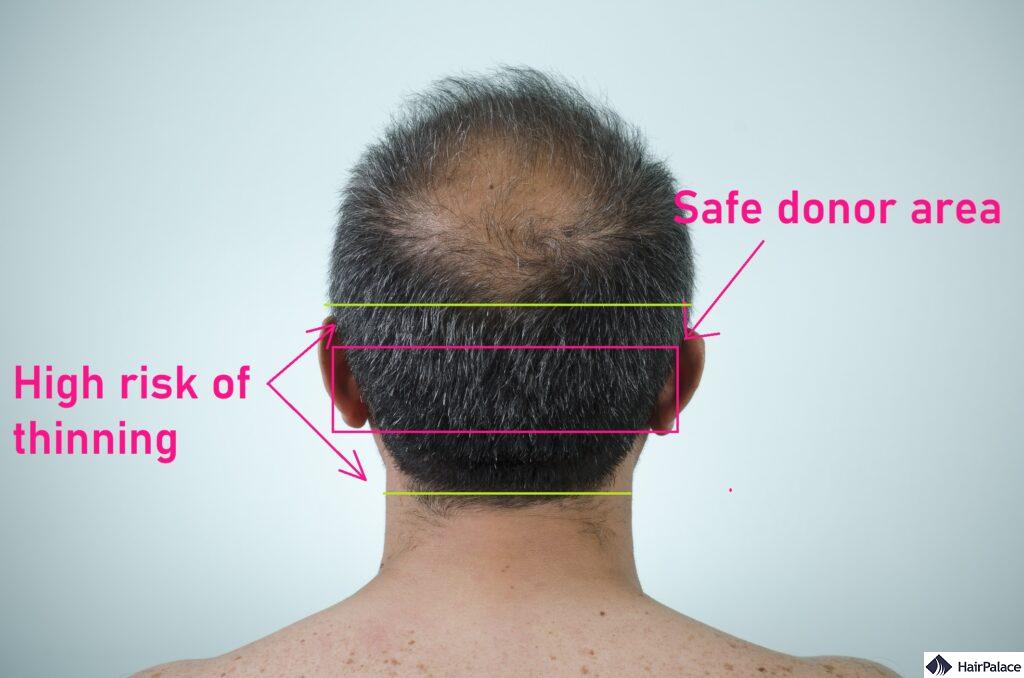 a second hair transplant must not overharvest the safe donor area
