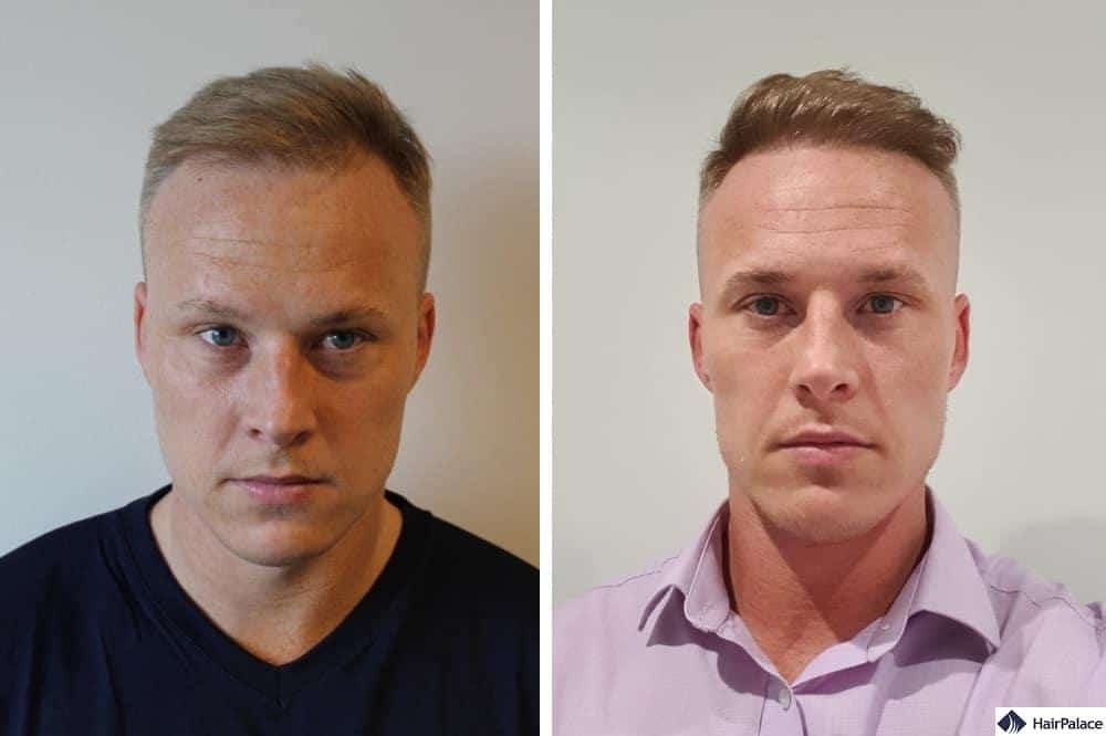 stuart before after Hair Palace FUE Hair Transplant in Budapest
