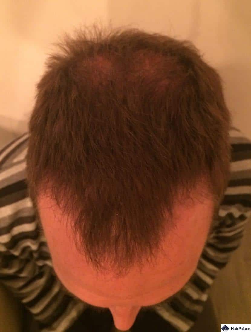 Hairline and frontal area 3 months after procedure