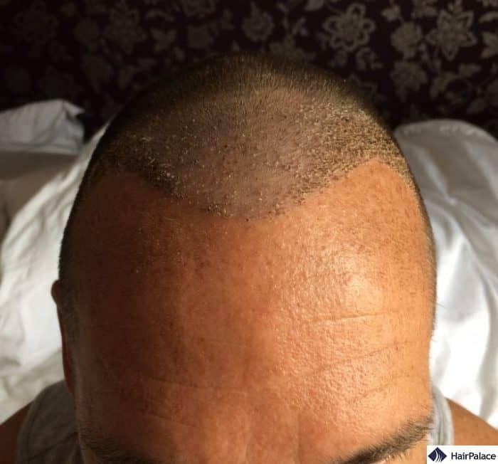 Implanted area with scabs 1 week after the hair transplant