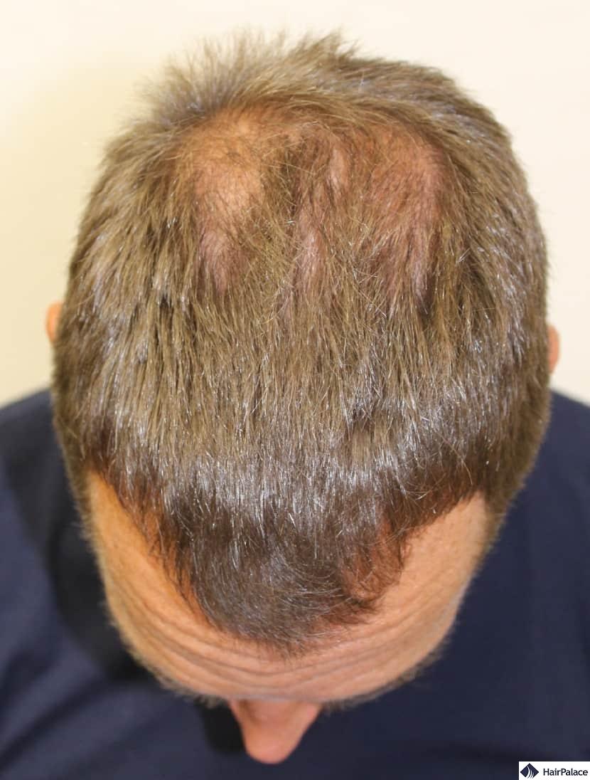 Hairline and the frontal area before the hair transplant