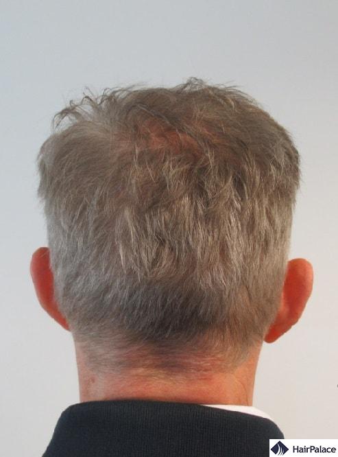 Thicker crown and fully healed donor area a year after the hair restoration